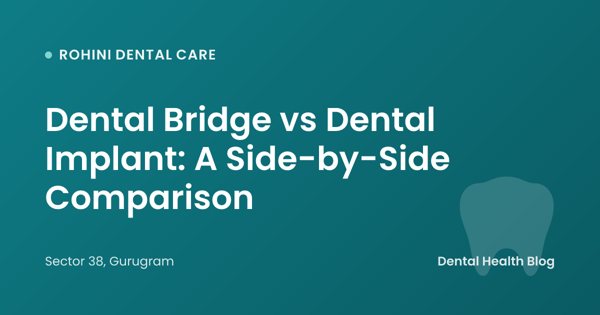 Dental Bridge vs Dental Implant: A Side-by-Side Comparison