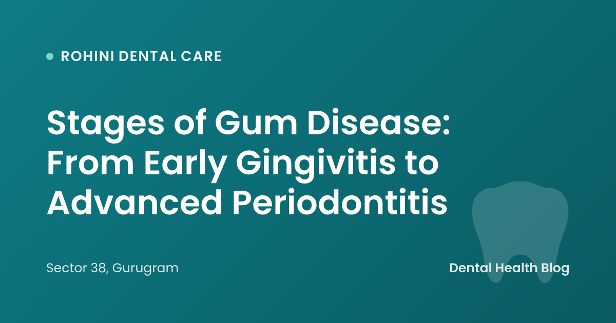 Stages of Gum Disease: From Early Gingivitis to Advanced Periodontitis